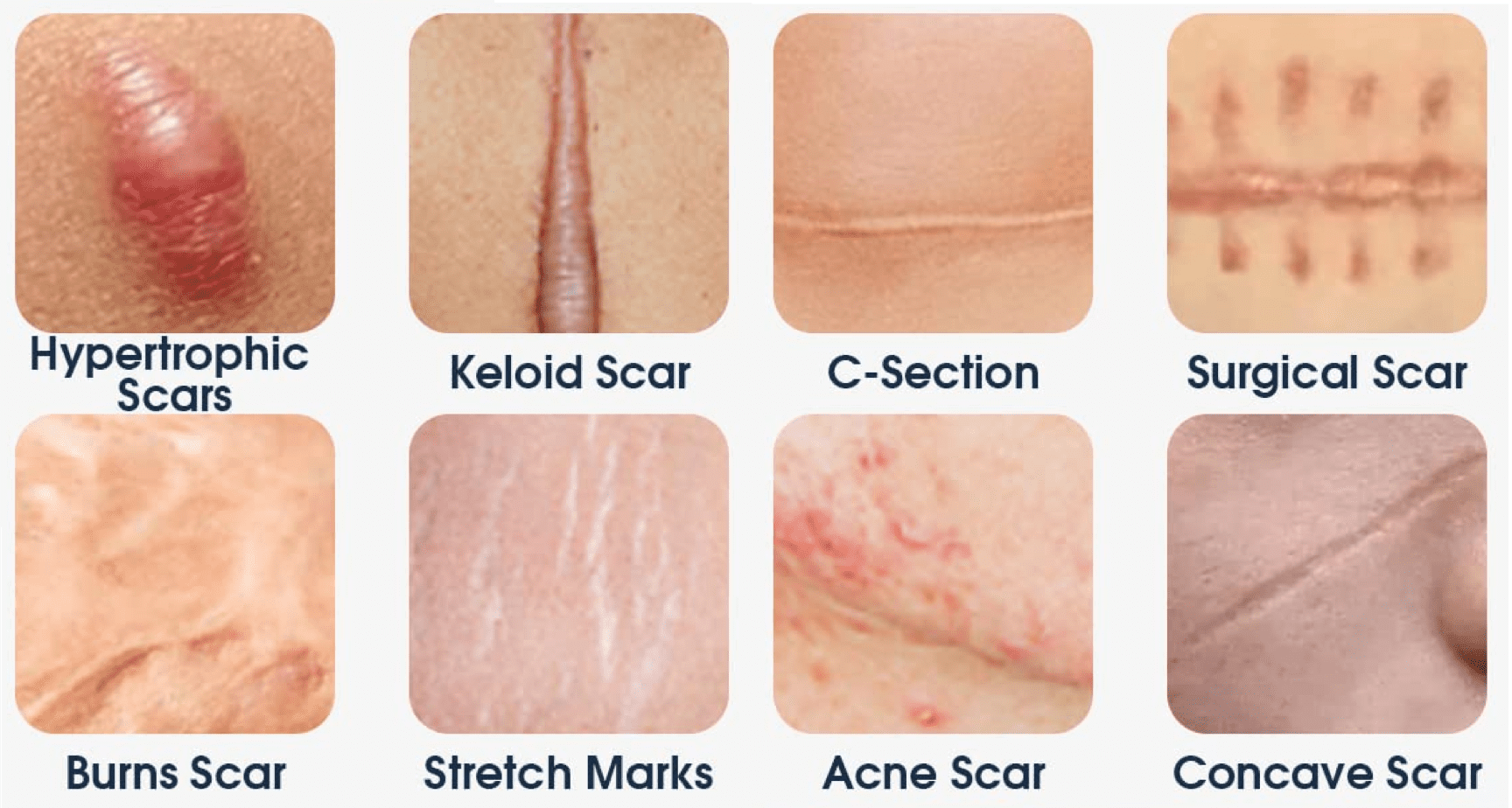 Scars Scars