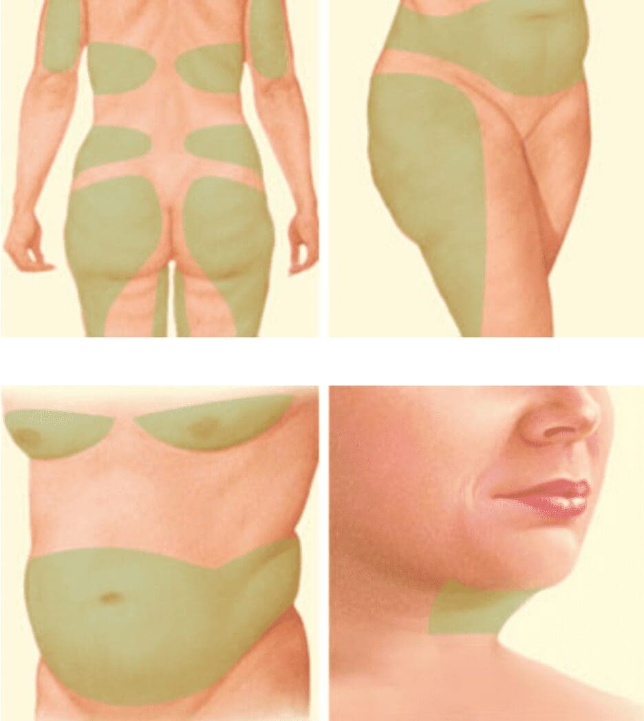 Areas Treated by Liposuction 2-13-2023 KD Areas Treated by Liposuction 2-13-2023 KD
