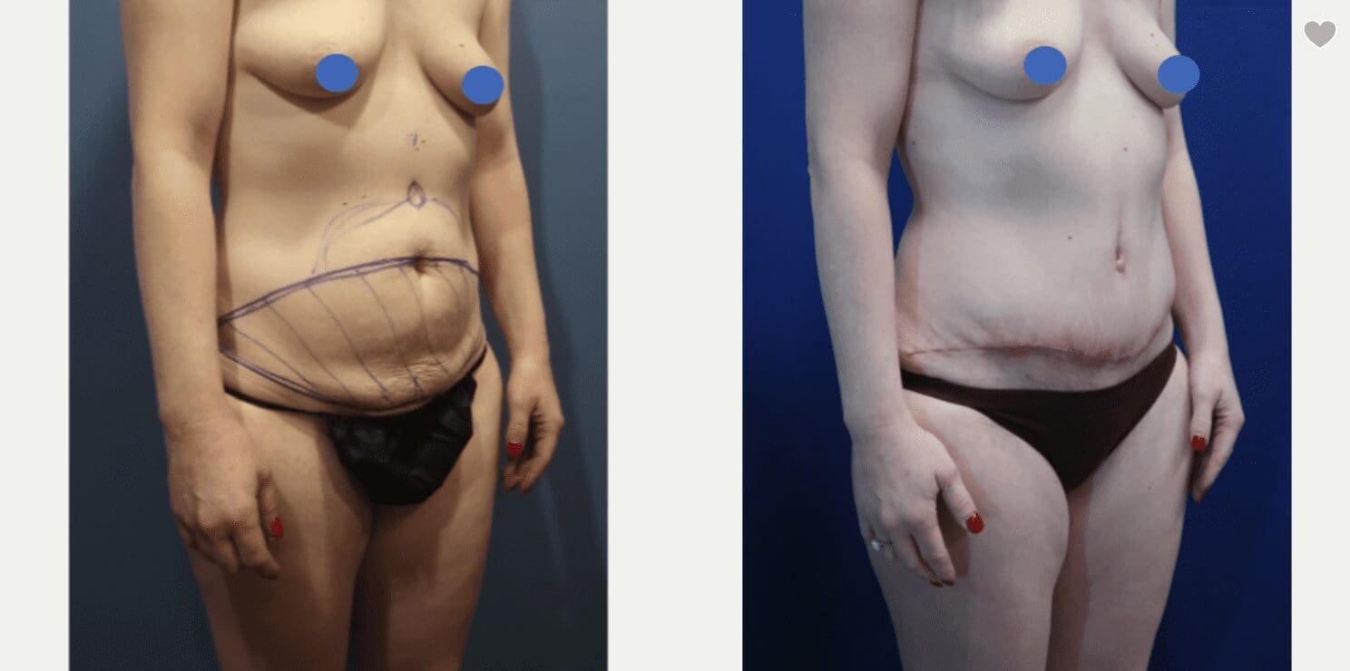 Mommy Makeover Before and After