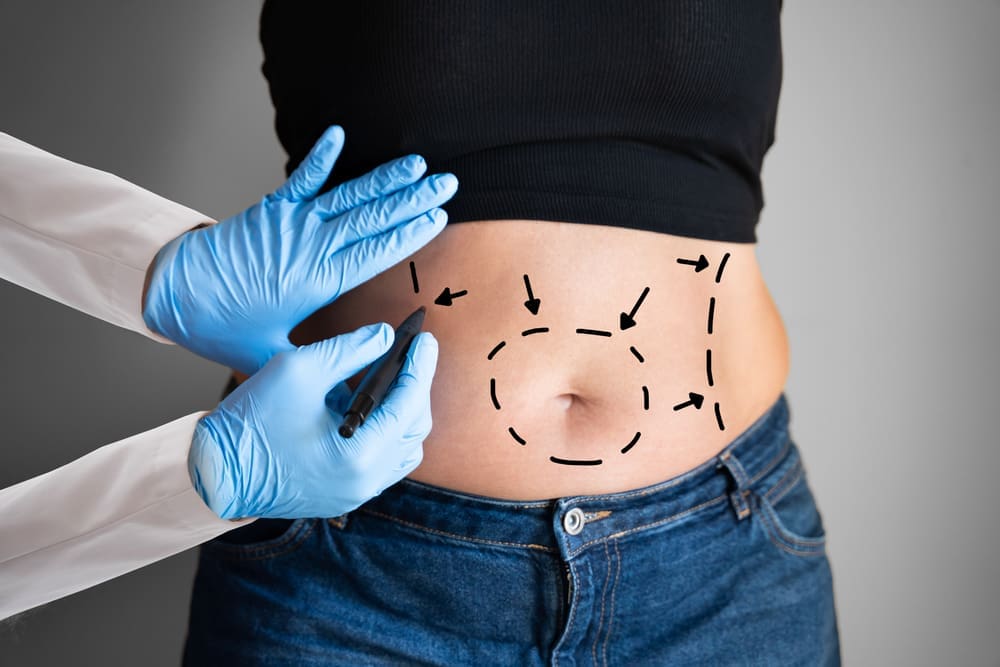 Abdominoplasty,Obesity,Surgery.,Aesthetic,Abdominal,Fat,Liposuction Abdominoplasty,Obesity,Surgery.,Aesthetic,Abdominal,Fat,Liposuction