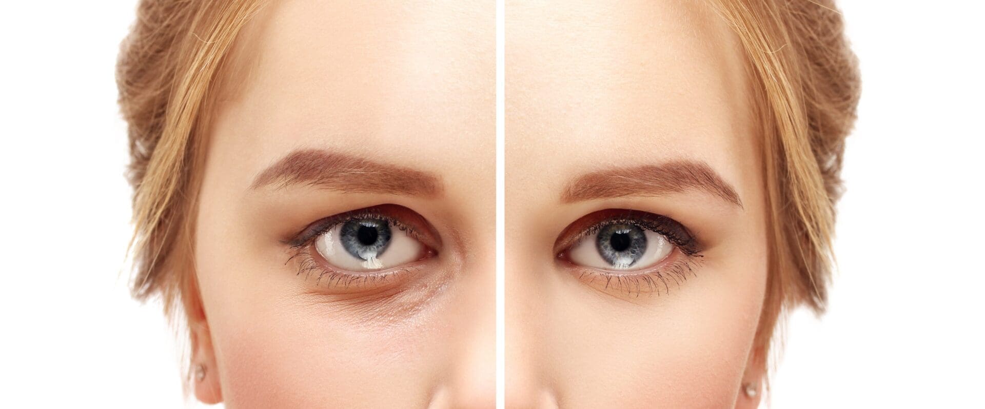 Eylid Lift Blepharoplasty 12-31-2023 KD iStock-628469746 Lower-Eyelid Blepharoplasty.Asian Eyelid Surgery.Upper blepharoplasty.Correcting the aging process