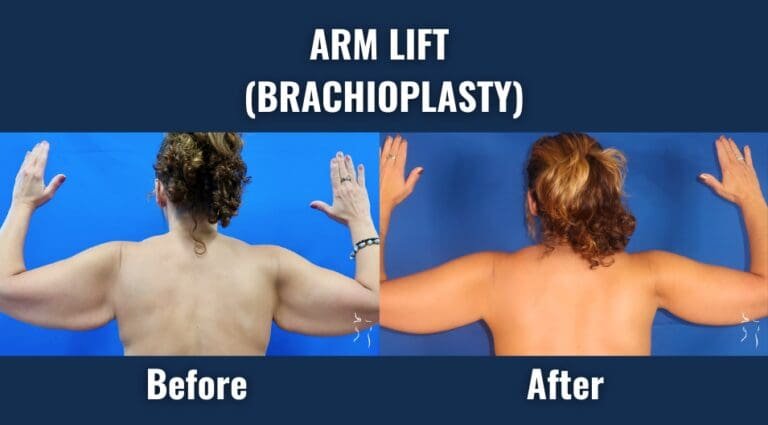 Before and after results of arm lift surgery (brachioplasty) showing significant reduction in upper arm sagging, viewed from the back.